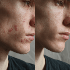 Acné preset preview