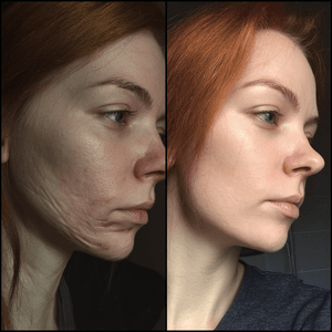 Cicatrices preset preview